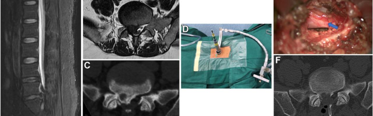 Robotic Spine Surgery
