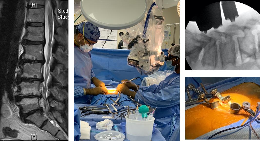 Benefits of Minimally Invasive Spine Surgery for Faster Recovery