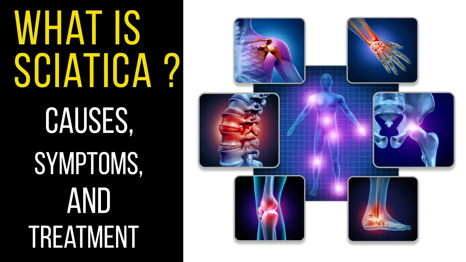 Sciatica Pain: Causes, Symptoms & Advanced Treatment Options